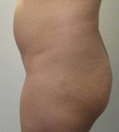 Brazilian Butt Lift Before & After Patient #6443
