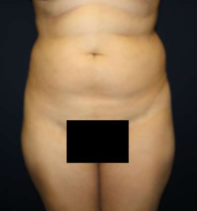 Brazilian Butt Lift Before & After Patient #6524