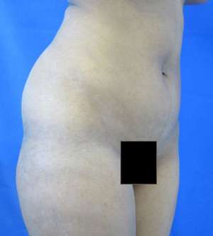 Brazilian Butt Lift Before & After Patient #6548