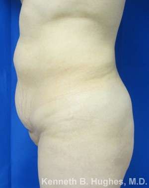 Brazilian Butt Lift Before & After Patient #6582