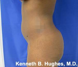 Brazilian Butt Lift Before & After Patient #6647
