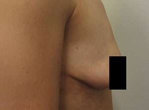 Breast Augmentation and Lift Before & After Patient #7177