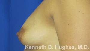 Breast Augmentation Implants Before & After Patient #7236
