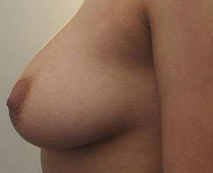 Breast Augmentation Implants Before & After Patient #7618