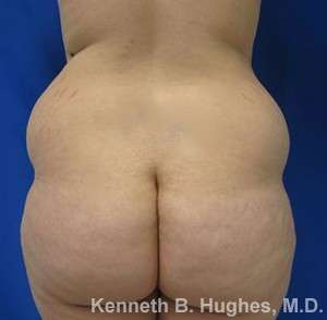 Body Lift Before & After Patient #5956