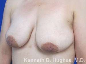 Breast Lift Before & After Patient #7854