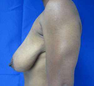 Breast Lift Before & After Patient #7927