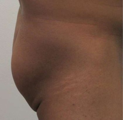 Butt Implants Before & After Patient #8186