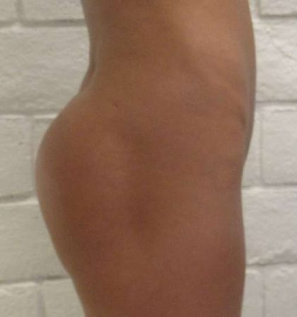 Butt Implants Before & After Patient #8193