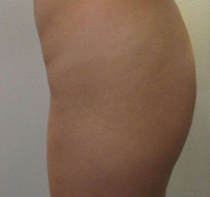 Butt Implants Before & After Patient #8214