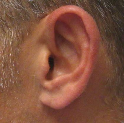 Ear Correction Before & After Patient #8373