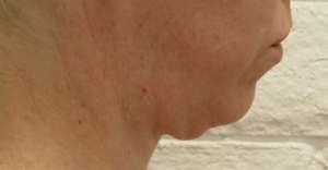 Facelift Before & After Patient #8534