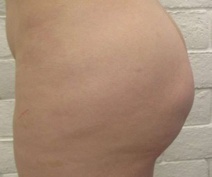 Fat Necrosis and Dead Fat Removal Before & After Patient #8586