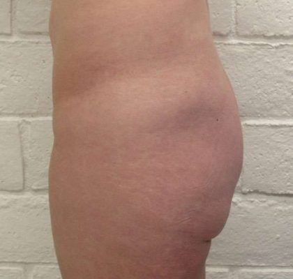 Body Lift Before & After Patient #5963