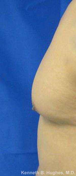 Gynecomastia Before & After Patient #8609