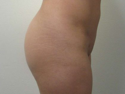 Liposuction Before & After Patient #8696