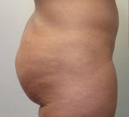 Liposuction Before & After Patient #8774