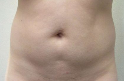 Liposuction Before & After Patient #8844