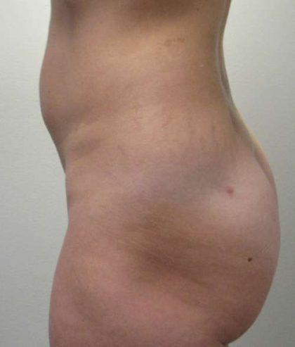 Liposuction Before & After Patient #8903