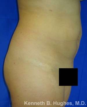 Liposuction Before & After Patient #9012