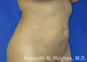 Liposuction Before & After Patient #9167