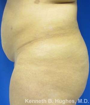 Liposuction Before & After Patient #9240