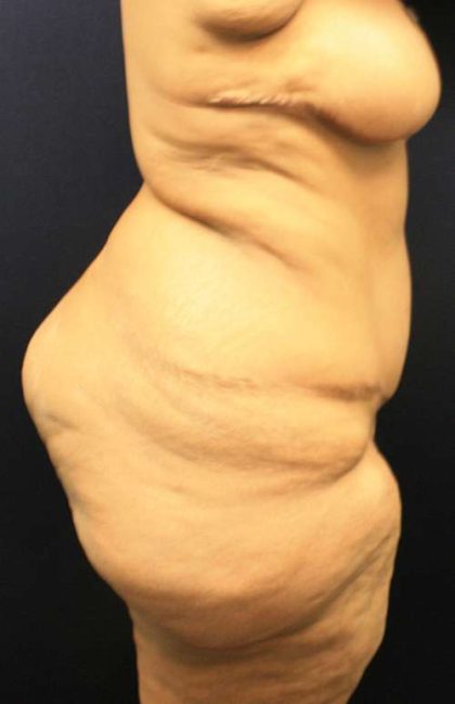 Body Lift Before & After Patient #6001