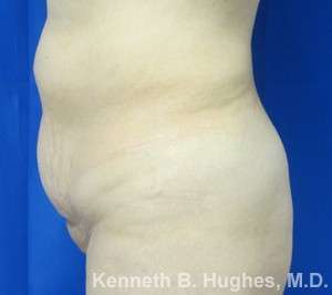 Liposuction Before & After Patient #9255