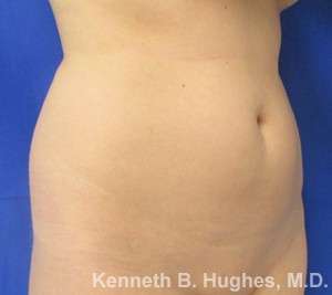 Liposuction Before & After Patient #9323