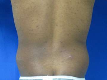 Liposuction Before & After Patient #9414