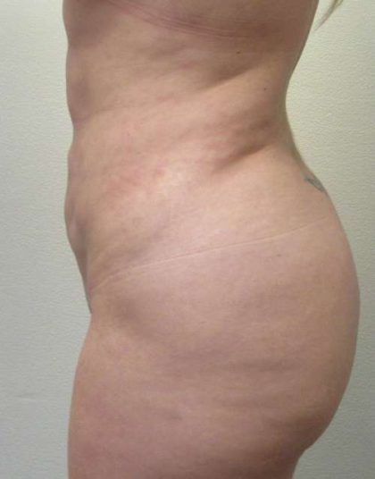 Liposuction Revision Cellulite Reduction Before & After Patient #9619