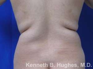Liposuction Revision Cellulite Reduction Before & After Patient #9658