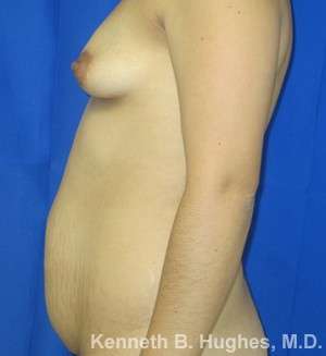 Mommy Makeover Before & After Patient #9827