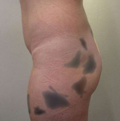 Silicone Injections Biopolymer Removal Before & After Patient #10337