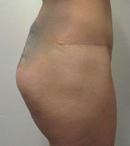 Silicone Injections Biopolymer Removal Before & After Patient #10347