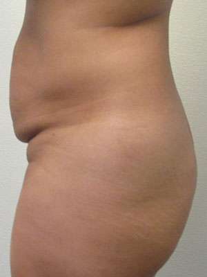 Tummy Tuck Before & After Patient #10410