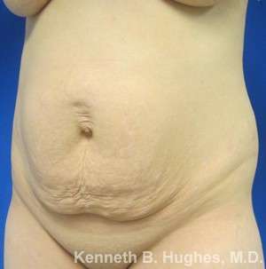 Tummy Tuck Before & After Patient #10508
