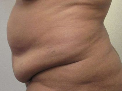 Tummy Tuck Before & After Patient #10585