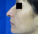Rhinoplasty Before & After Patient #10313