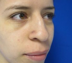 Rhinoplasty Before & After Patient #10306