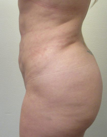 Back Before & After Patient #10988
