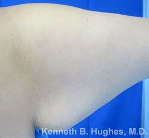 Arm Lift Before & After Patient #5932