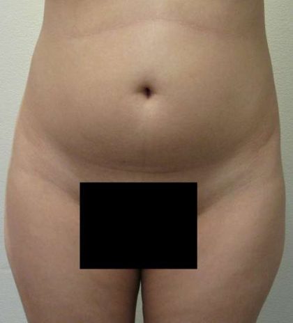 Brazilian Butt Lift Before & After Patient #6443