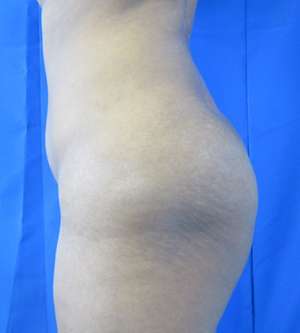 Brazilian Butt Lift Before & After Patient #6548