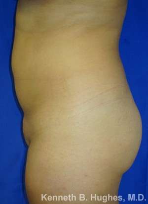Brazilian Butt Lift Before & After Patient #6557