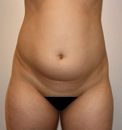 Brazilian Butt Lift Before & After Patient #6987
