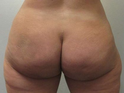 Liposuction Before & After Patient #8774