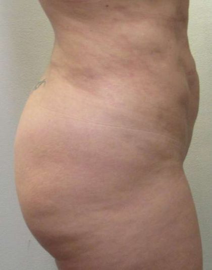 Liposuction Revision Cellulite Reduction Before & After Patient #9619
