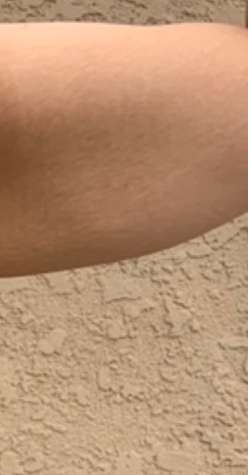 Bodytite Before & After Patient #6164