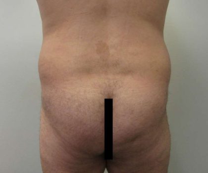 Brazilian Butt Lift Before & After Patient #6223